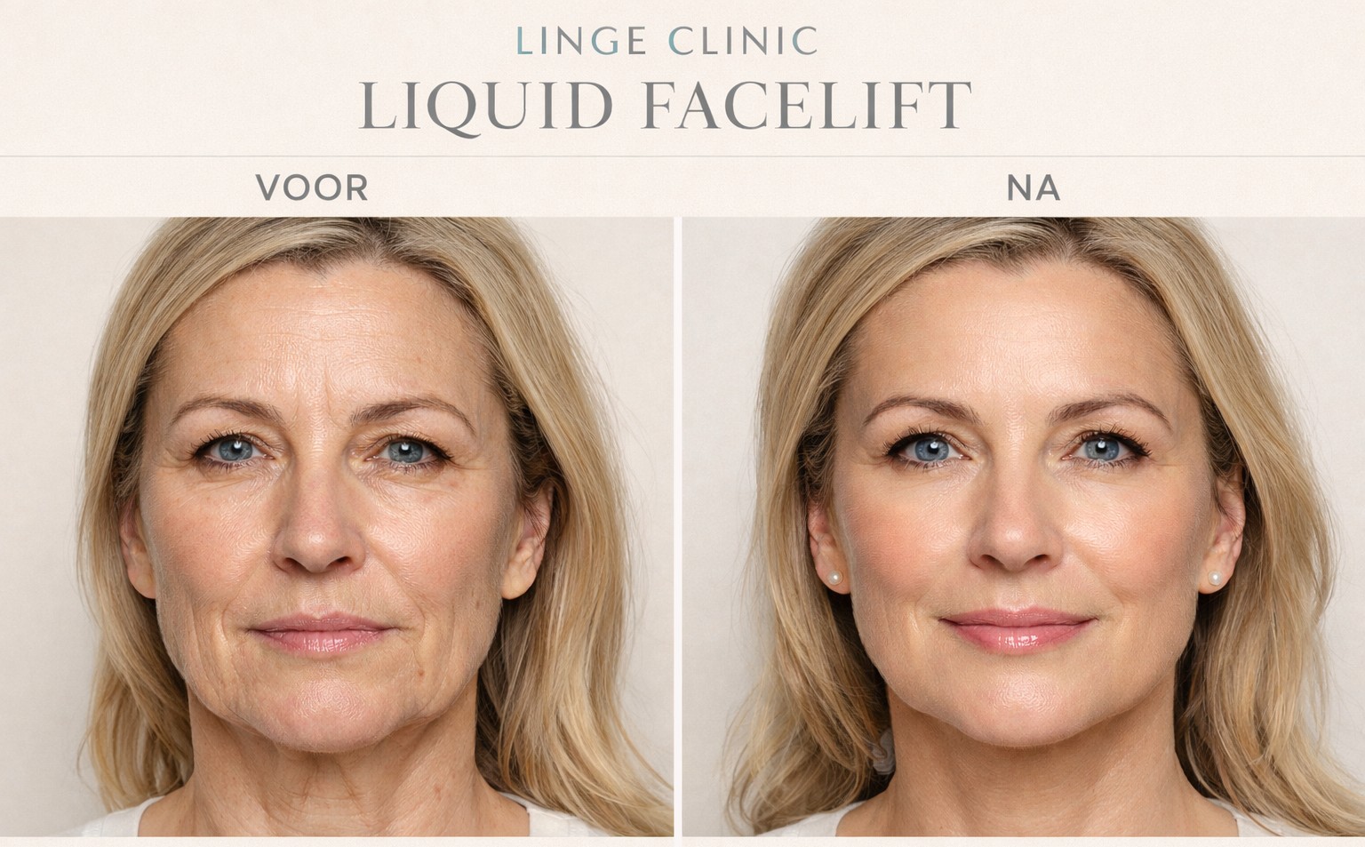 De Linge Clinic Liquid Facelift