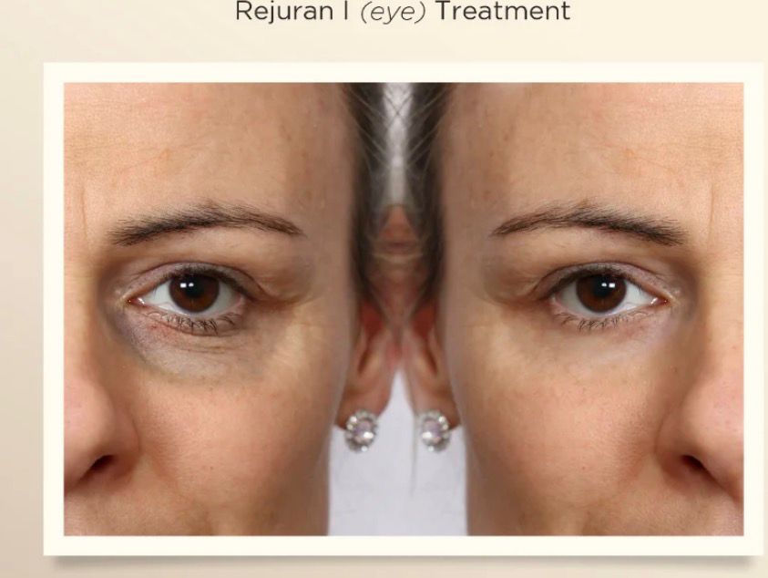 Rejuran oog behandeling voor/na resultaat
